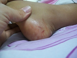 Puncture marks indicate the rattlesnake bite on the heel of a 9-year-old. Puncture marks indicate the rattlesnake bite on the heel of a 9-year-old.